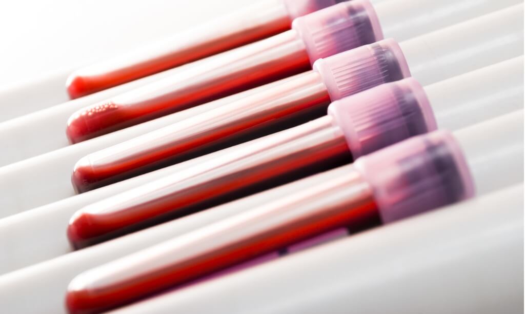 Blood samples representing liquid biopsies for MRD testing. MRD tests work by collecting and analyzing circulating tumor DNA from liquid biopsies.