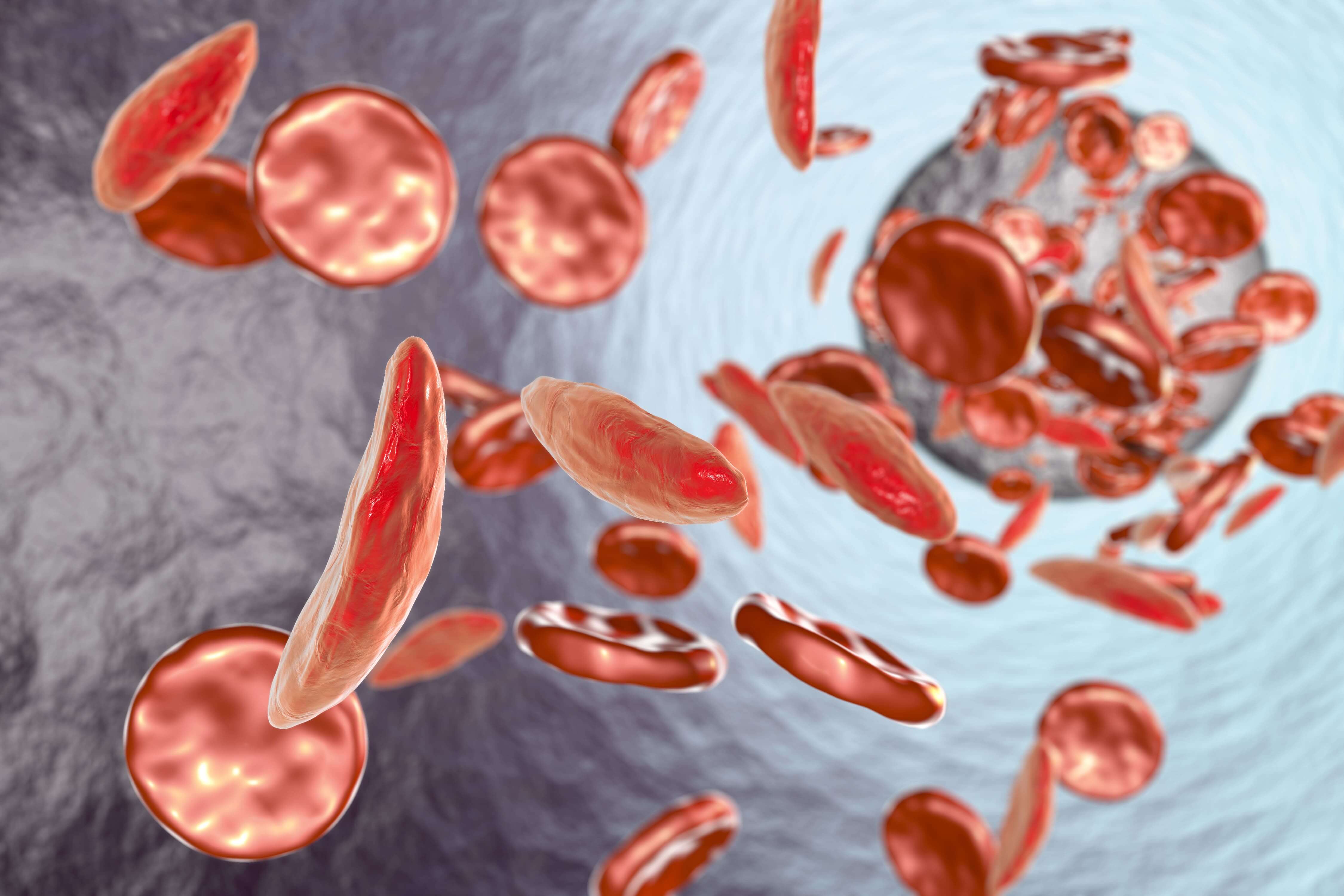 Possible Gene Therapy Cures for Sickle Cell Disease Arrive