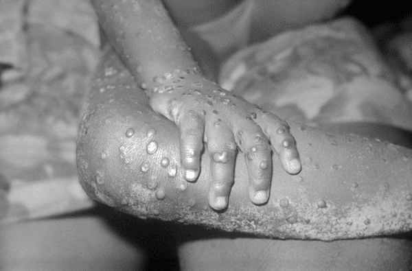 Child with monkeypox lesions visible dotted along its leg.